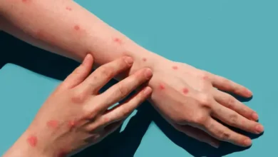 These claims are misleading and false. Mpox is a distinct disease caused by the monkeypox virus and has no connection to Covid-19 vaccines. Misleading claims on social media may cause unnecessary fear and confusion, and it's crucial to rely on verified information for health-related decisions.